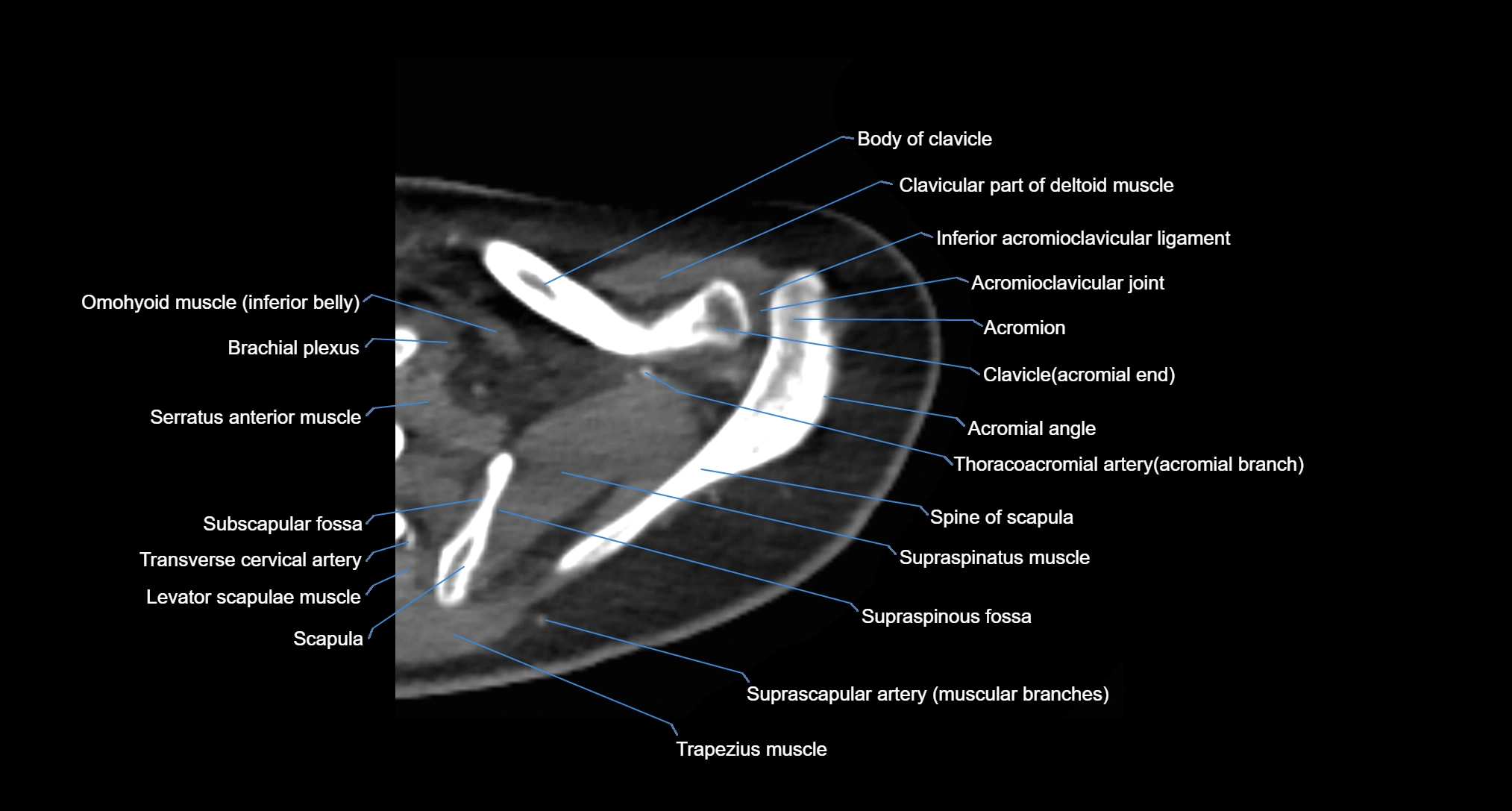 CT Shoulder axial cross sectional anatomy labelled radiology image -00016.webp